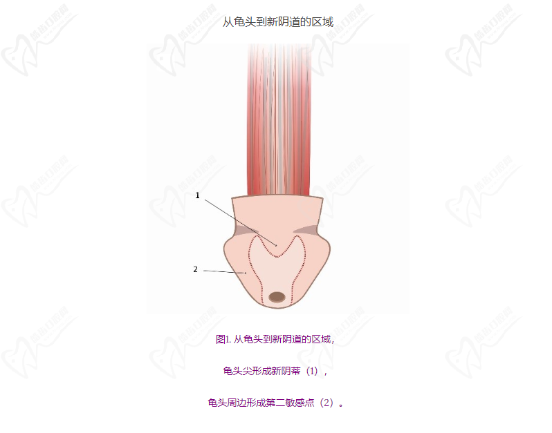 泰国咖蒙整形医院男变女阴道成型术