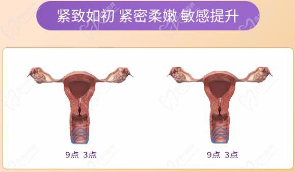 鳄鱼圈紧缩手术价格表