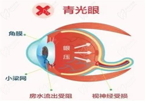 孙兴怀做青光眼手术怎么样