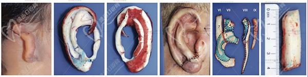 八大处耳再造手术哪个医生好