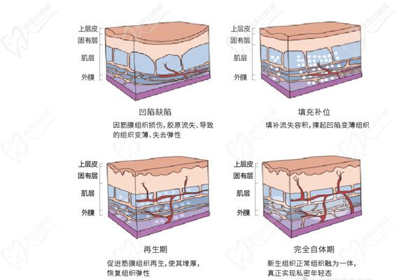 丽芙莎初恋针效 果怎么样