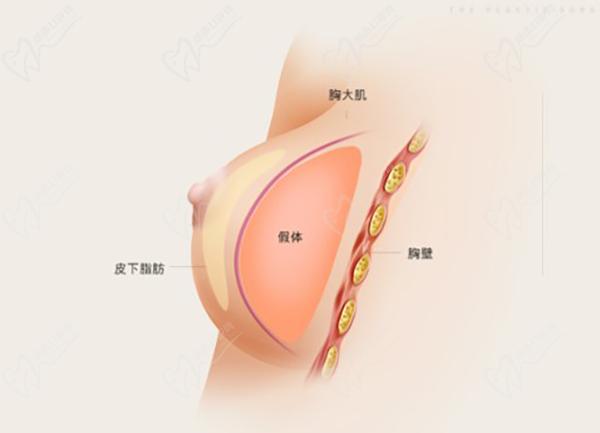 南京做胸部整形医院医生排名榜