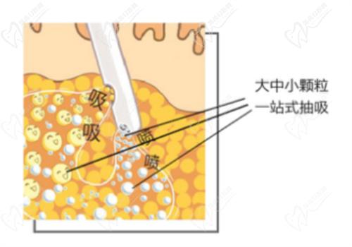 上海薇琳抽脂成效好