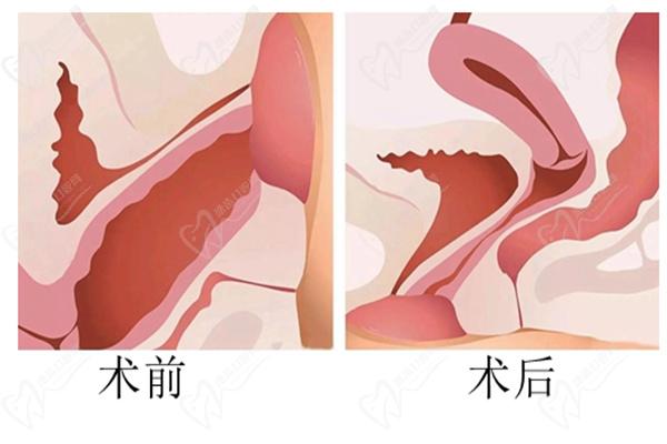 八爪鱼缩阴术对比图