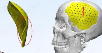 钛网和peek材料补颅骨哪种更好