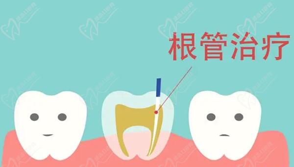 湛江根管治疗一颗牙齿多少钱