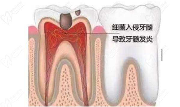 湛江根管治疗一颗牙齿多少钱？湛江根管治疗可以报销吗