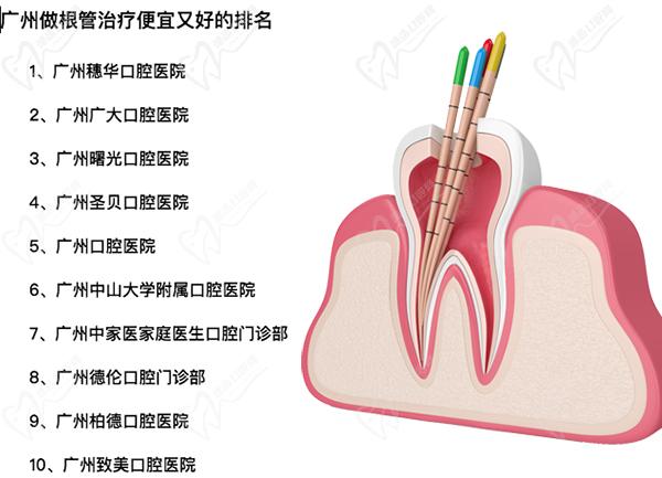 广州根管治疗哪个医院好？广州做根管治疗便宜又好的口腔排名在本文