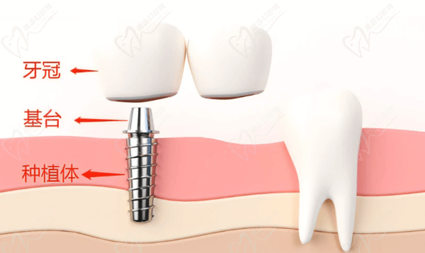 种植牙结构