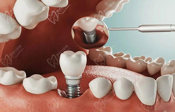 鄂尔多斯青蕾口腔医院种植牙