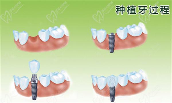 种植牙过程