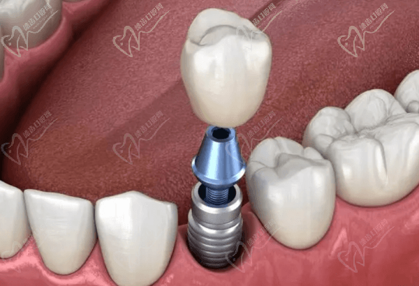 种植牙价格