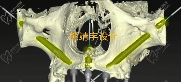 北京极简一站式口腔集采种植牙价格