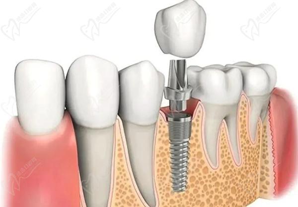 台州种植牙多少钱一颗2024新版？请参考台州牙科医院种植牙价目表