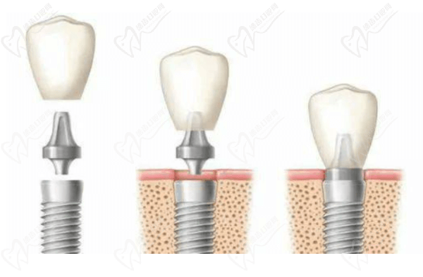 种植牙型号