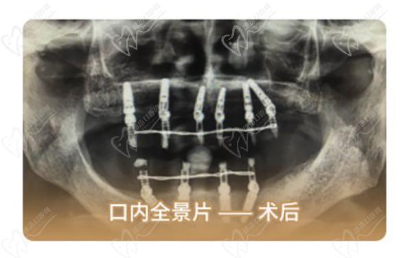 北京中诺口腔医院种牙靠谱吗？e+立得用数字化种植牙真的能当天种牙当天用