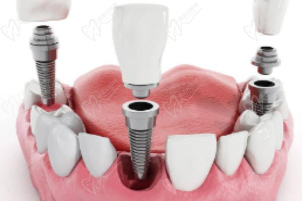 把假牙改成种植牙减少脱落风险