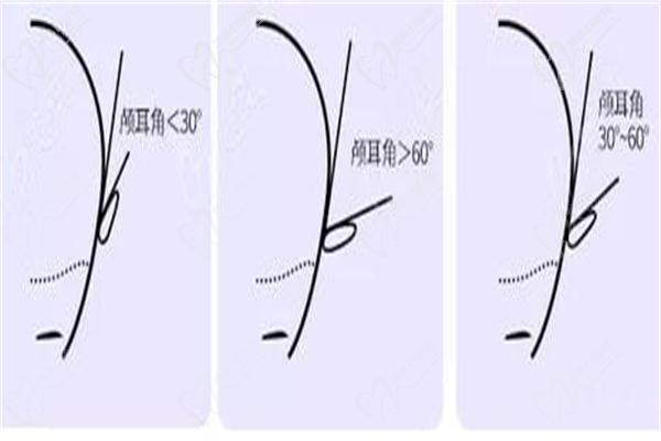 兜风耳矫正角度