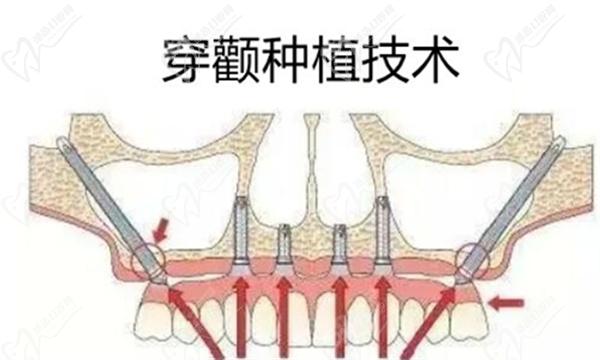 穿颧种植