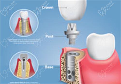 深圳爱康健口腔种植牙怎么样.jpg