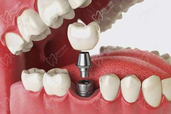 宁波好牙口腔医院种植牙多少钱价格表