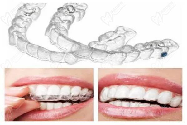 成都团圆口腔医院隐形矫正
