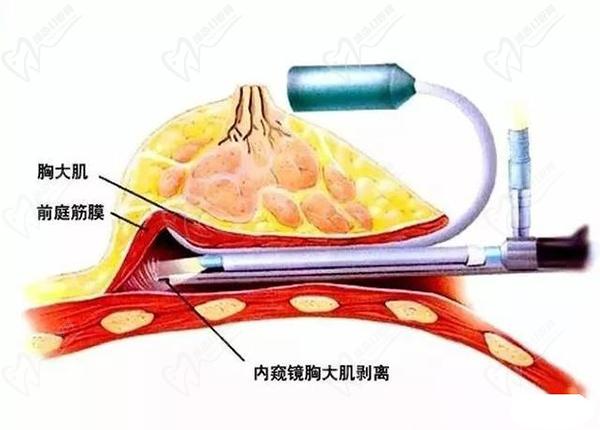 南京做胸部整形医院医生排名榜