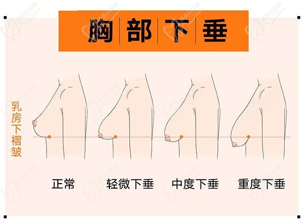 南京做胸部整形医院医生排名榜