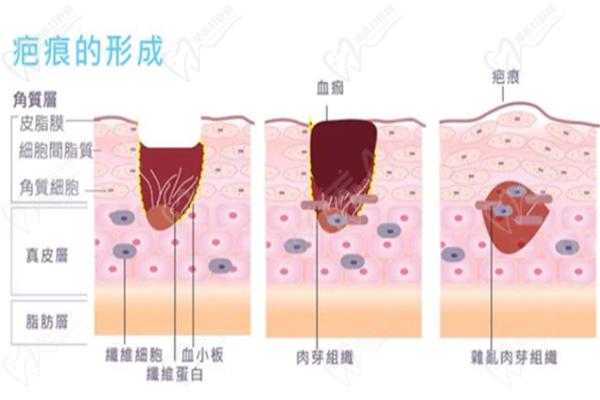 韩国疤痕修复技术到底有多好