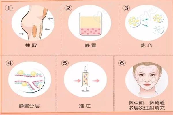 北大医学院整形外科脂肪整形价格