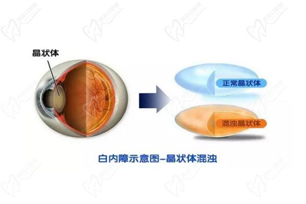 白内障晶体植入手术