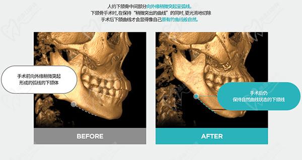 韩国ts整形外科点下颌角