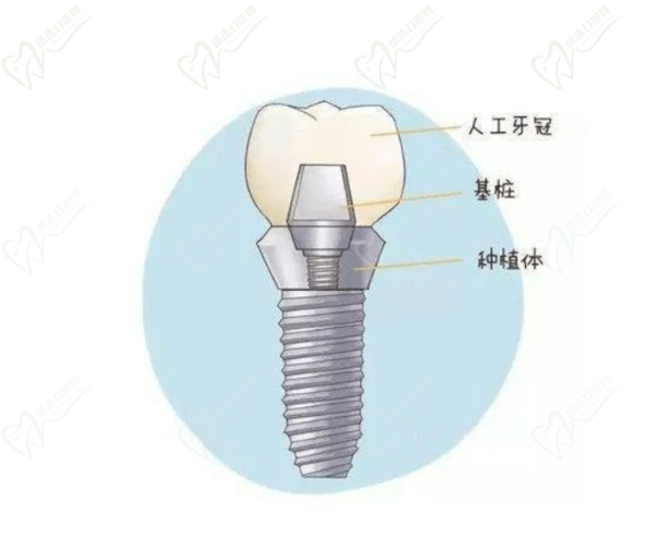 种植牙结构