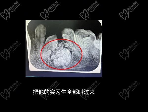 牙齿长瘤子一定要做手术吗？拔掉57颗牙是什么样的体验