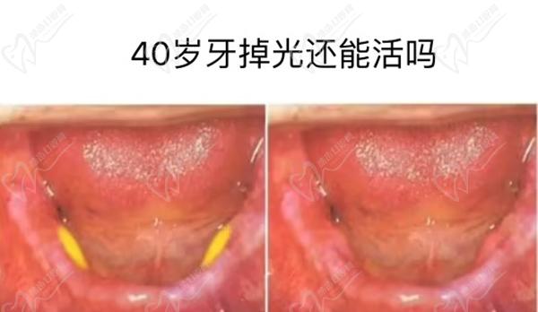 40岁牙掉光还能活吗?请问40岁牙齿掉光了怎么处理好