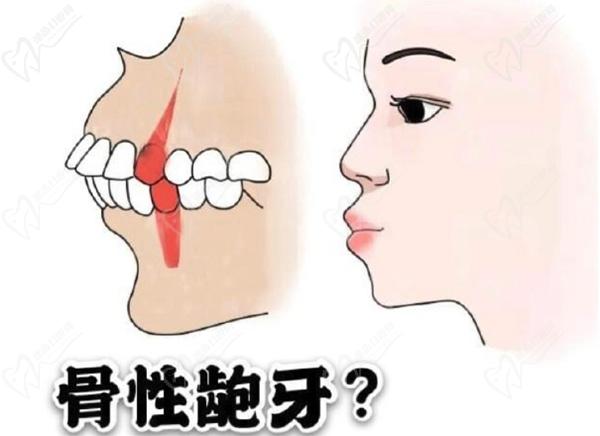 侯振杰正牙手术谁做过？请问侯振杰微创正颌手术怎么样