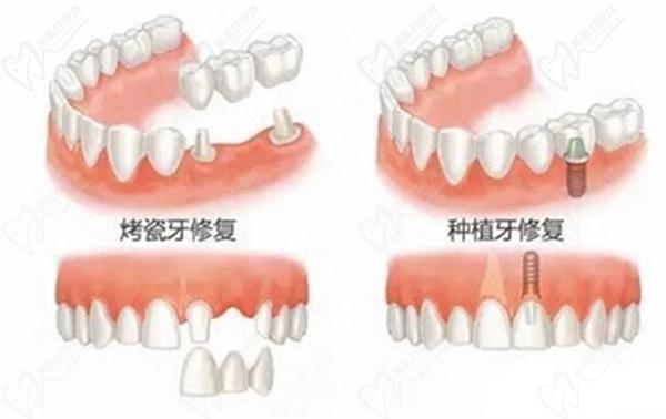 牙齿缺失修复