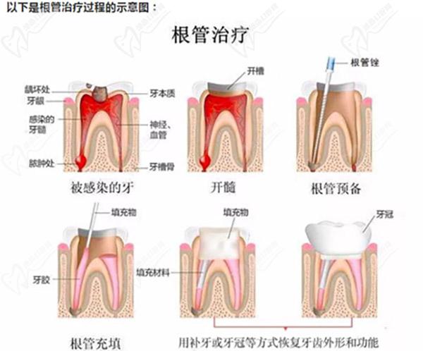 根管治疗