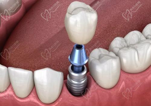 日照博恩口腔医院种植牙怎么样