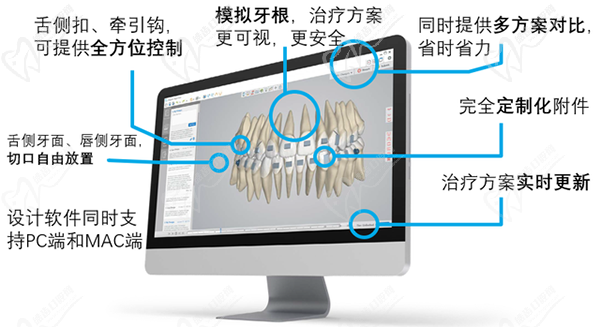 spark隐形牙套优势