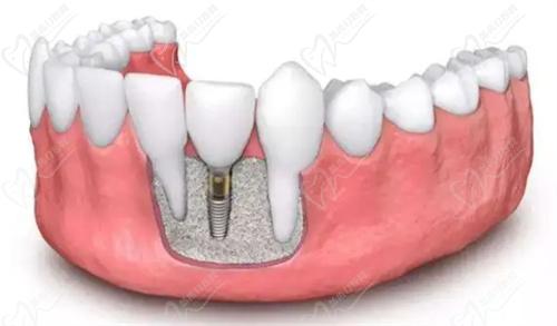 酒泉口腔医院种植牙多钱？