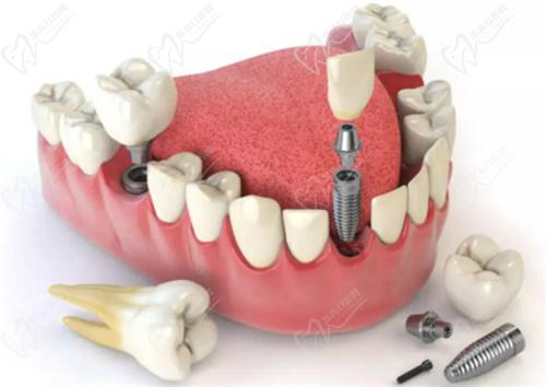 酒泉口腔医院种植牙收费标准