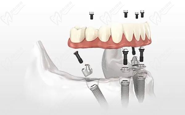 2023口腔医院全口种植牙价格是多少？在线查询全口种植牙价目表