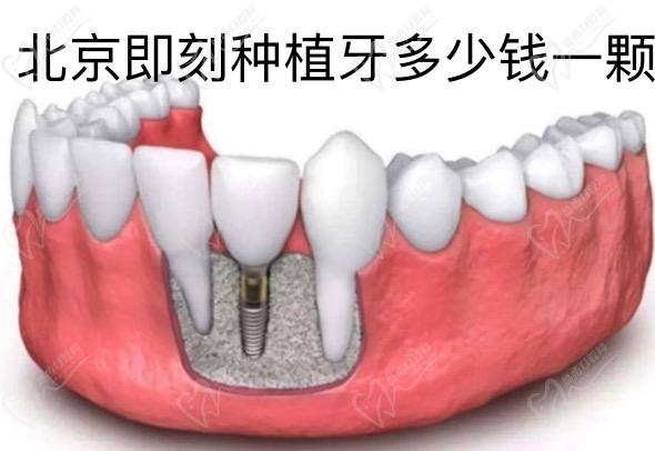 北京即刻种植牙多少钱一颗？即刻种植牙手术费用一览表及医院名单有了