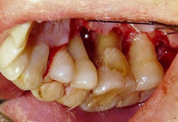 牙周炎照片