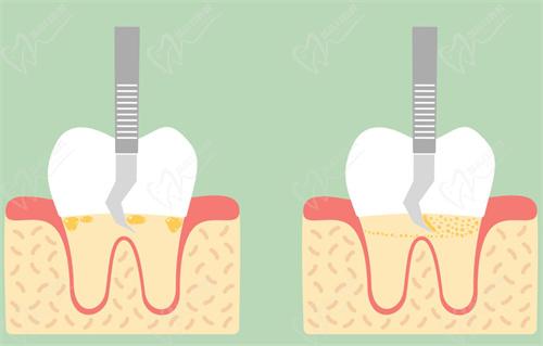 龈下刮治的费用需要多少钱？