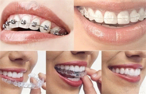 大同天使牙博士口腔牙齿矫正的各种方法