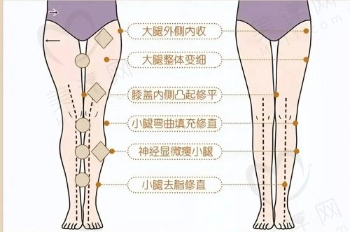 直腿术的优缺点汇总