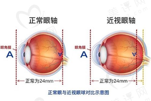 眼轴超过26就会终身增长吗