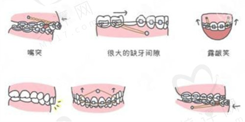 正畸骨钉适用症